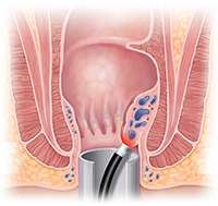 Cross section of anus showing laser treating hemorrhoid.