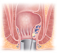 Cross section of anus showing needle releasing medication into hemorrhoid.