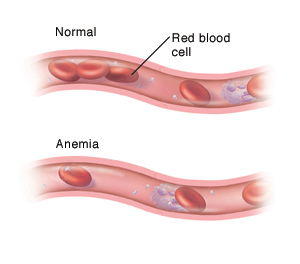 Normal blood vessel with red blood cells and other blood components, compared to a blood vessel with low red blood cells due to anemia.