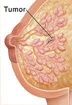 Cross section of breast showing noninvasive breast cancer.