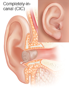 Cross section of ear showing outer, inner, and middle ear structures with completely-in-canal hearing aid in place with inset of external view.