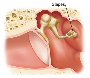 Cross section of ear showing outer, inner, and middle ear structures with damaged stapes.