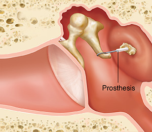 Cross section of ear showing outer, inner, and middle ear structures with prosthesis and tissue graft.