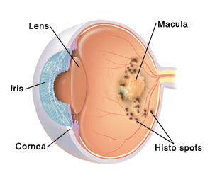Three-quarter view of cross section of eye showing histo spots around macula.