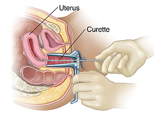 Cross section of female pelvis from the side showing doctor's hands inserting scope and instrument.