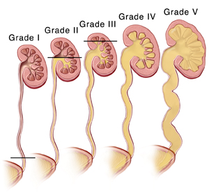 Cross section of kidneys and ureters showing five grades of vesicoureteral reflux.