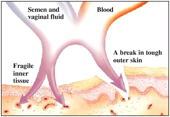 Cross section of fragile inner tissue next to break in tough outer skin. Arrows show semen, vaginal fluid, and blood entering skin through break and directly into inner tissue.