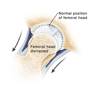 Cross section of hip joint with arrows showing femoral head of thighbone being pulled out of socket. Dotted line shows normal position of femoral head in socket.