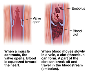 Cross section of muscle and vein showing open valve with arrow showing blood moving up. Cross section of varicose vein with thrombus and emboli.