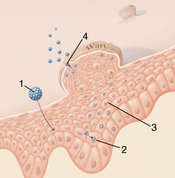 Cross section of skin with HPV wart showing virus infecting skin cells, causing wart to form, and shedding more viruses.