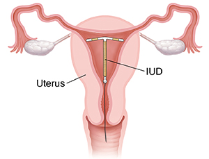 Cross section of uterus and vagina showing IUD in place inside uterus.