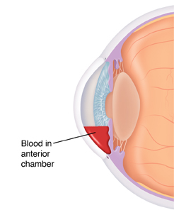 Cross section side view of front of eye showing blood in anterior chamber.