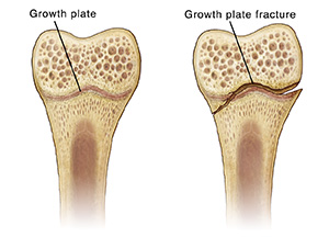 Cross-section of bone showing a growth plate and fractured growth plate