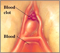 Cutaway view of blood clot