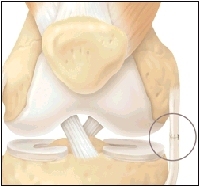 Cutaway view of knee showing the medial collateral ligament