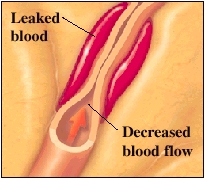 Cutaway view of narrowed artery showing leaked blood and decreased blood flow
