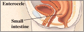 Cutaway view of rectum and vagina