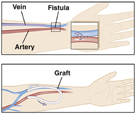 Forearm showing fistula created between artery and vein. Forearm showing graft placed between artery and vein.