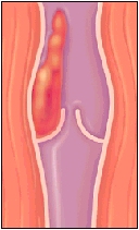 Cutaway view of vein