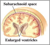 Cutaway view of ventricles showing enlarged ventricles and subarachnoid space
