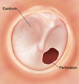 Eardrum with hole.