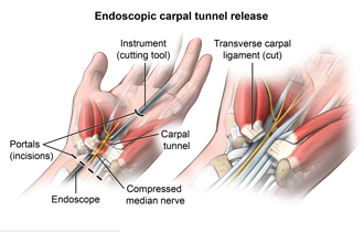Endoscopic carpal tunnel surgery showing the cutting tool, the incisions, the endoscop, the carpal tunnel, and the compressed median nerve