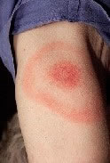 Erythema Migrans Rash