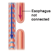 Side view of trachea and esophagus showing esophageal artresia.