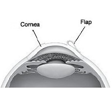 Cross section of eye showing flap in cornea.