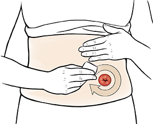 Female abdomen showing hands applying skin barrier around stoma. 