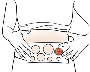 Female abdomen showing hands holding measuring guide to stoma.