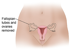 Female pelvis showing reproductive structures.  Dotted lines show removal of Fallopian tubes and ovaries.