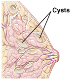 Кисты в грудных железах. Субареолярная киста молочной железы. Жировая киста молочной железы. Что такое киста молочной железы у женщин.