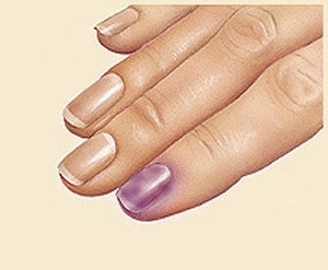 Fingers showing subungual hematoma under index finger fingernail.