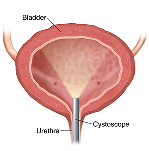 Front view cross section of bladder showing cystoscope inserted through ureter.