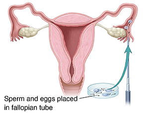 Front view cross section of female reproductive tract showing instrument injecting sperm and eggs into fallopian tube.