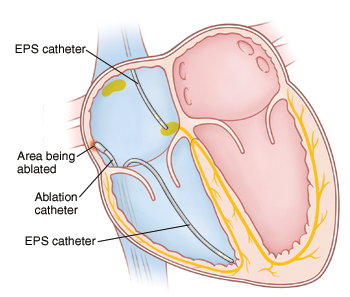 Cross section of heart showing catheters inserted into right atrium and ventricle for ablation procedure.