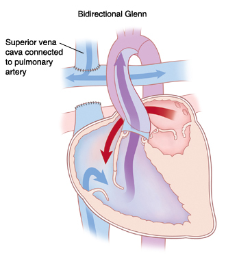 Front view cross section of heart showing bidirectional Glenn procedure for hypoplastic left ventricle. Superior vena cava is connected to pulmonary artery. Arrows show blood flowing from left atrium to right ventricle and mixing with blood from inferior vena cava, then being pumped out aorta.