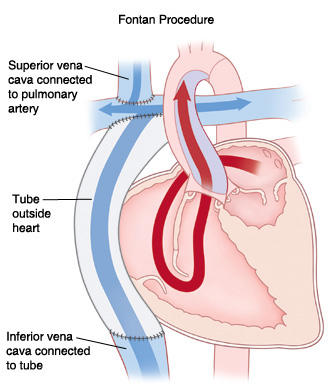 Front view cross section of heart showing Fontan procedure for hypoplastic left ventricle. Superior vena cava is connected to pulmonary artery. Tube outside heart is connected to inferior vena cava at bottom and superior vena cava at top. Arrows show blood flowing from left atrium to right ventricle, then being pumped out aorta.
