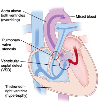 Front view cross section of heart showing Tetralogy of Fallot: aorta above both ventricles (overriding), pulmonary stenosis, ventricular septal defect (VSD), and thickened right ventricle (hypertrophy). Arrows show blood flowing from left and right sides of heart through VSD to mix and be pumped out of aorta. Some blood flows from right side of heart to pulmonary artery.