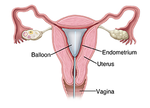 Front view cross section of uterus showing catheter inserted through vagina and ablation balloon inside uterus.