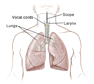 Direct Laryngoscopy Bronchoscopy – ZSJSE