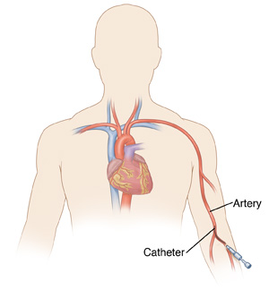 Front view of a male torso showing the heart and radial artery of the arm. A catheter is inserted into the radial artery.