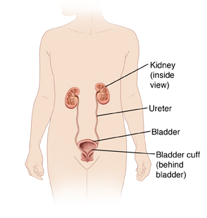 Front view of body outline showing kidneys, ureters, and bladder. Left kidney shows inside. Bladder cuff is at end of ureter, next to bladder wall.