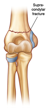 Front view of elbow joint showing supracondylar fracture across lower part of humerus.