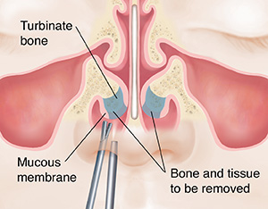 Front view of face showing surgical instruments removing part of turbinate bone in nose. 