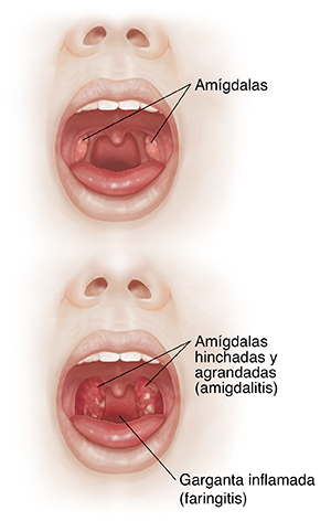 Front view of face with open mouth comparing oral cavity and tonsils with inflamed throat and enlarged tonsils.