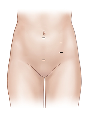 Front view of female abdomen showing laparoscopic incision sites in pelvic area.