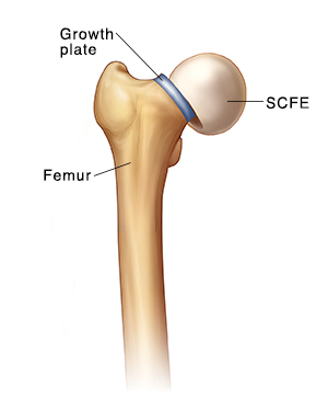 Front view of femur showing femoral head slipping off growth plate (SCFE).