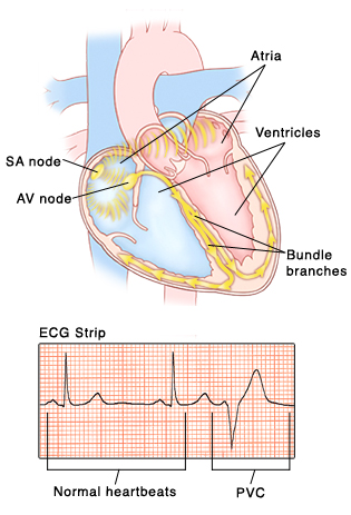 Front view of heart showing atria on top and ventricles on bottom. SA node and AV node are in right atrium. Bundle branch nerves are in wall between ventricles and curve into ventricle walls. Signals from AV node travel to AV node and into bundle branches. Inset of ECG strip with pattern of normal heartbeat compared with irregular pattern of PVC.